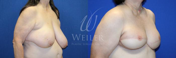 Before & After Breast Cancer Reconstruction Case 1231 Left Oblique View in Baton Rouge, New Orleans, & Lafayette, Louisiana