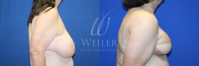 Before & After Breast Cancer Reconstruction Case 1231 Left Side View in Baton Rouge, New Orleans, & Lafayette, Louisiana