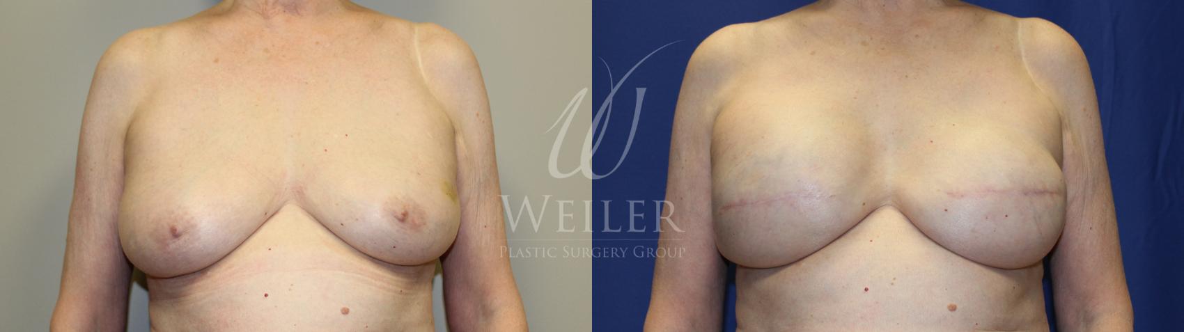 Before & After Breast Cancer Reconstruction Case 1232 Front View in Baton Rouge, New Orleans, & Lafayette, Louisiana