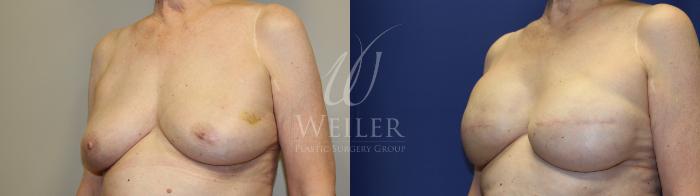 Before & After Breast Cancer Reconstruction Case 1232 Right Oblique View in Baton Rouge, New Orleans, & Lafayette, Louisiana