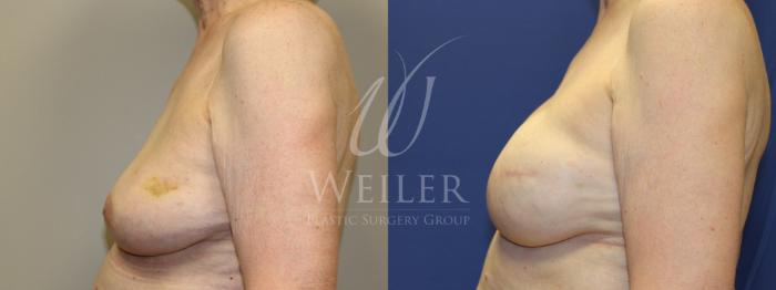 Before & After Breast Cancer Reconstruction Case 1232 Right Side View in Baton Rouge, New Orleans, & Lafayette, Louisiana