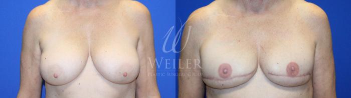 Before & After Breast Cancer Reconstruction Case 1233 Front View in Baton Rouge, New Orleans, & Lafayette, Louisiana
