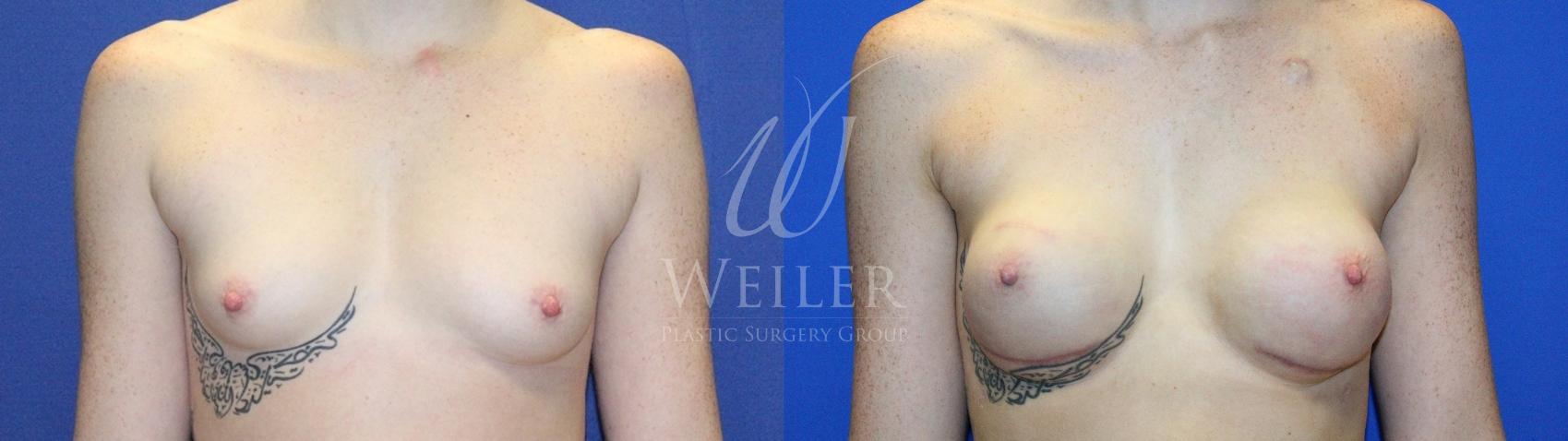 Before & After Breast Cancer Reconstruction Case 1236 Front View in Baton Rouge, New Orleans, & Lafayette, Louisiana