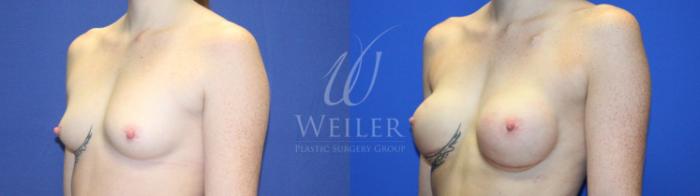 Before & After Breast Cancer Reconstruction Case 1236 Right Oblique View in Baton Rouge, New Orleans, & Lafayette, Louisiana