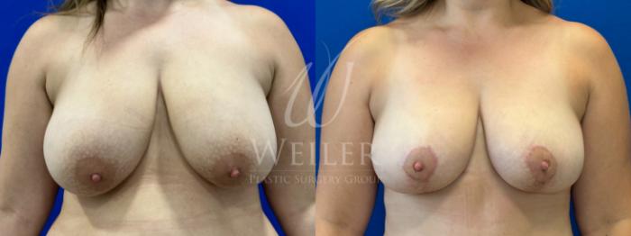 Before & After Breast Lift Case 1038 Front View in Baton Rouge, New Orleans, & Lafayette, Louisiana
