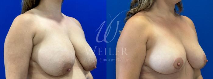 Before & After Breast Lift Case 1038 Right Oblique View in Baton Rouge, New Orleans, & Lafayette, Louisiana