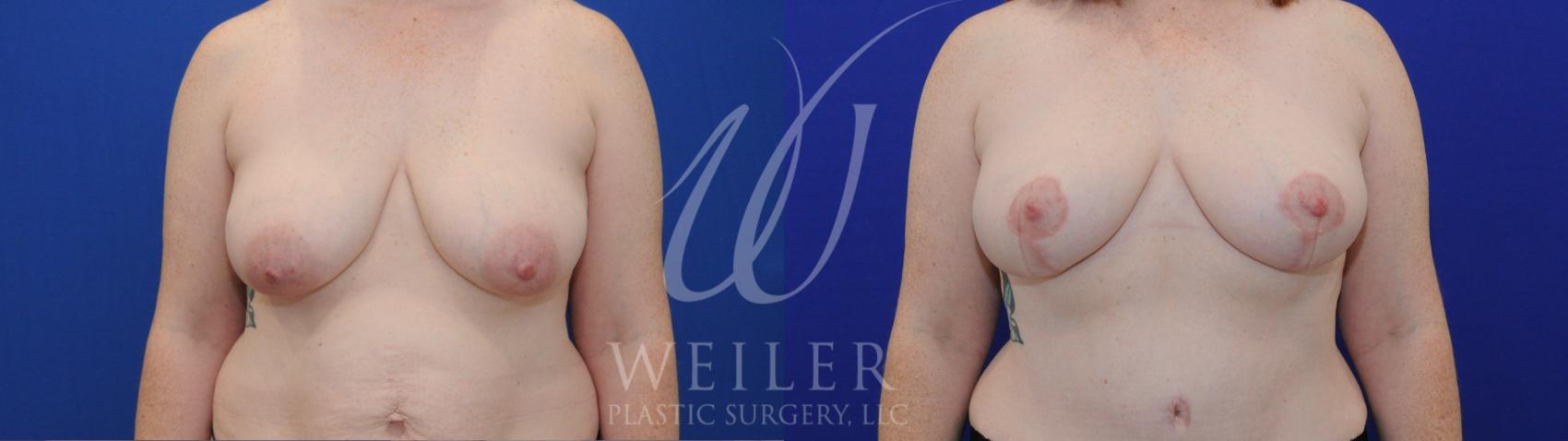 Before & After Breast Lift Case 1046 Front View in Baton Rouge, Louisiana