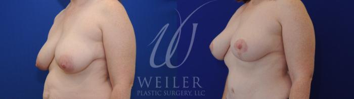 Before & After Breast Lift Case 1046 Left Oblique View in Baton Rouge, New Orleans, & Lafayette, Louisiana