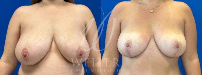 Before & After Breast Lift Case 1105 Front View in Baton Rouge, New Orleans, & Lafayette, Louisiana