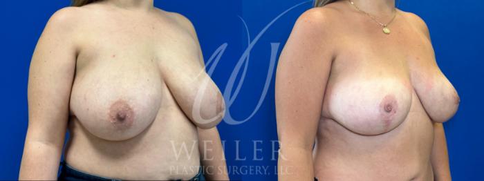 Before & After Breast Lift Case 1105 Right Oblique View in Baton Rouge, New Orleans, & Lafayette, Louisiana