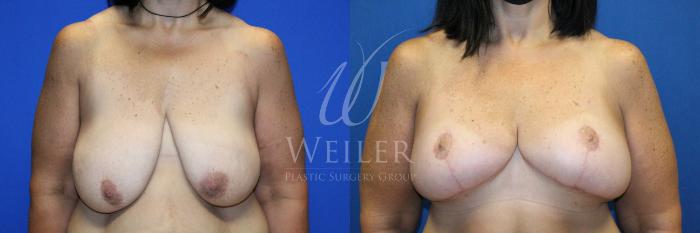 Before & After Breast Lift Case 1136 Front View in Baton Rouge, New Orleans, & Lafayette, Louisiana