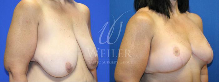 Before & After Breast Lift Case 1136 Left Oblique View in Baton Rouge, New Orleans, & Lafayette, Louisiana