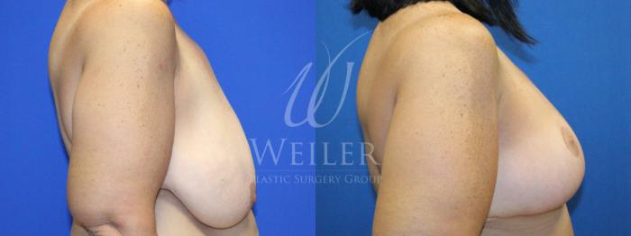 Before & After Breast Lift Case 1136 Left Side View in Baton Rouge, New Orleans, & Lafayette, Louisiana