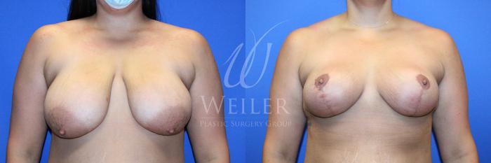 Before & After Breast Lift Case 1234 Front View in Baton Rouge, New Orleans, & Lafayette, Louisiana