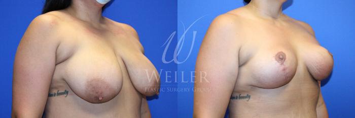 Before & After Breast Lift Case 1234 Left Oblique View in Baton Rouge, New Orleans, & Lafayette, Louisiana