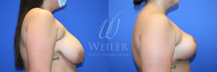 Before & After Breast Lift Case 1234 Left Side View in Baton Rouge, New Orleans, & Lafayette, Louisiana