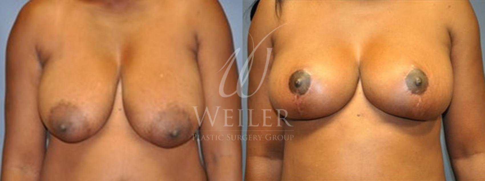Before & After Breast Lift Case 145 View #1 View in Baton Rouge, Louisiana