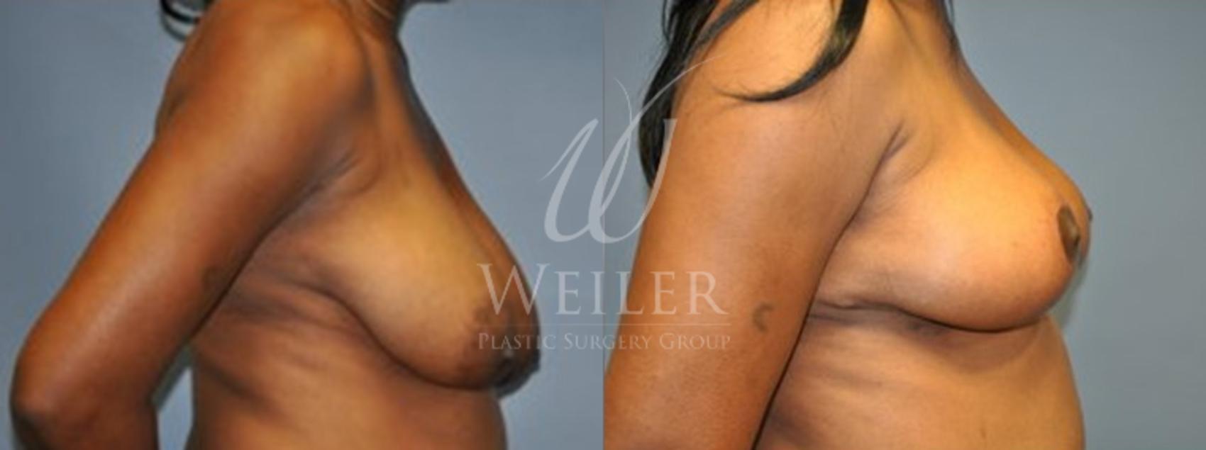 Before & After Breast Lift Case 145 View #2 View in Baton Rouge, Louisiana