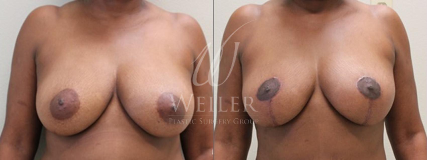 Before & After Breast Lift Case 146 View #1 View in Baton Rouge, Louisiana