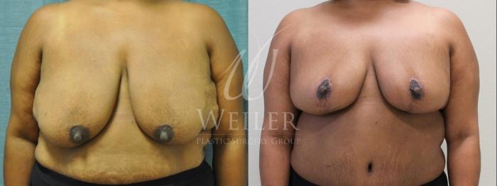 Before & After Breast Lift Case 154 View #1 View in Baton Rouge, New Orleans, & Lafayette, Louisiana