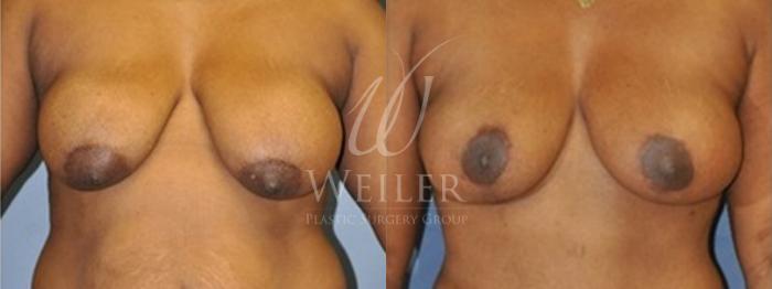Before & After Breast Lift Case 157 View #1 View in Baton Rouge, Louisiana