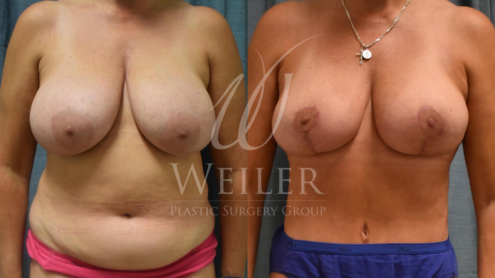Before & After Breast Lift Case 164 Front View in Baton Rouge, Louisiana