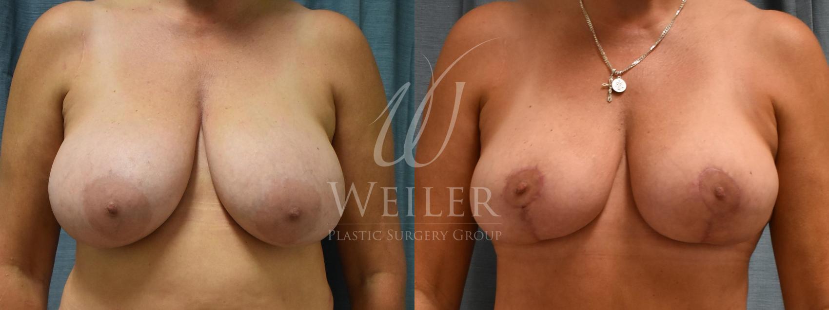 Before & After Breast Lift Case 164 View #1 View in Baton Rouge, Louisiana