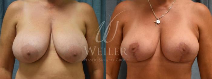 Before & After Breast Lift Case 164 View #1 View in Baton Rouge, New Orleans, & Lafayette, Louisiana