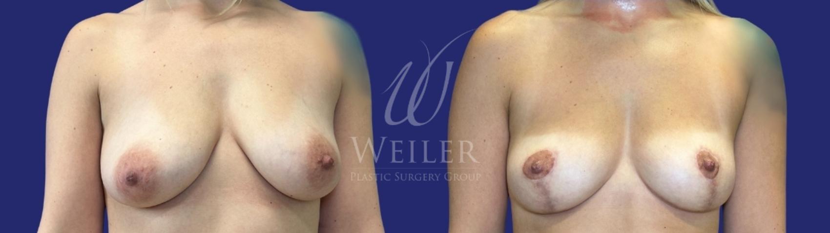Before & After Breast Lift Case 1678 Front View in Baton Rouge, New Orleans, & Lafayette, Louisiana
