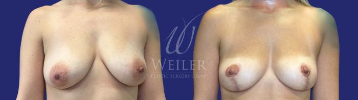 Before & After Breast Lift Case 1678 Front View in Baton Rouge, New Orleans, & Lafayette, Louisiana