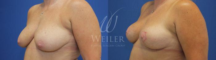 Before & After Breast Lift Case 658 Left Oblique View in Baton Rouge, Louisiana