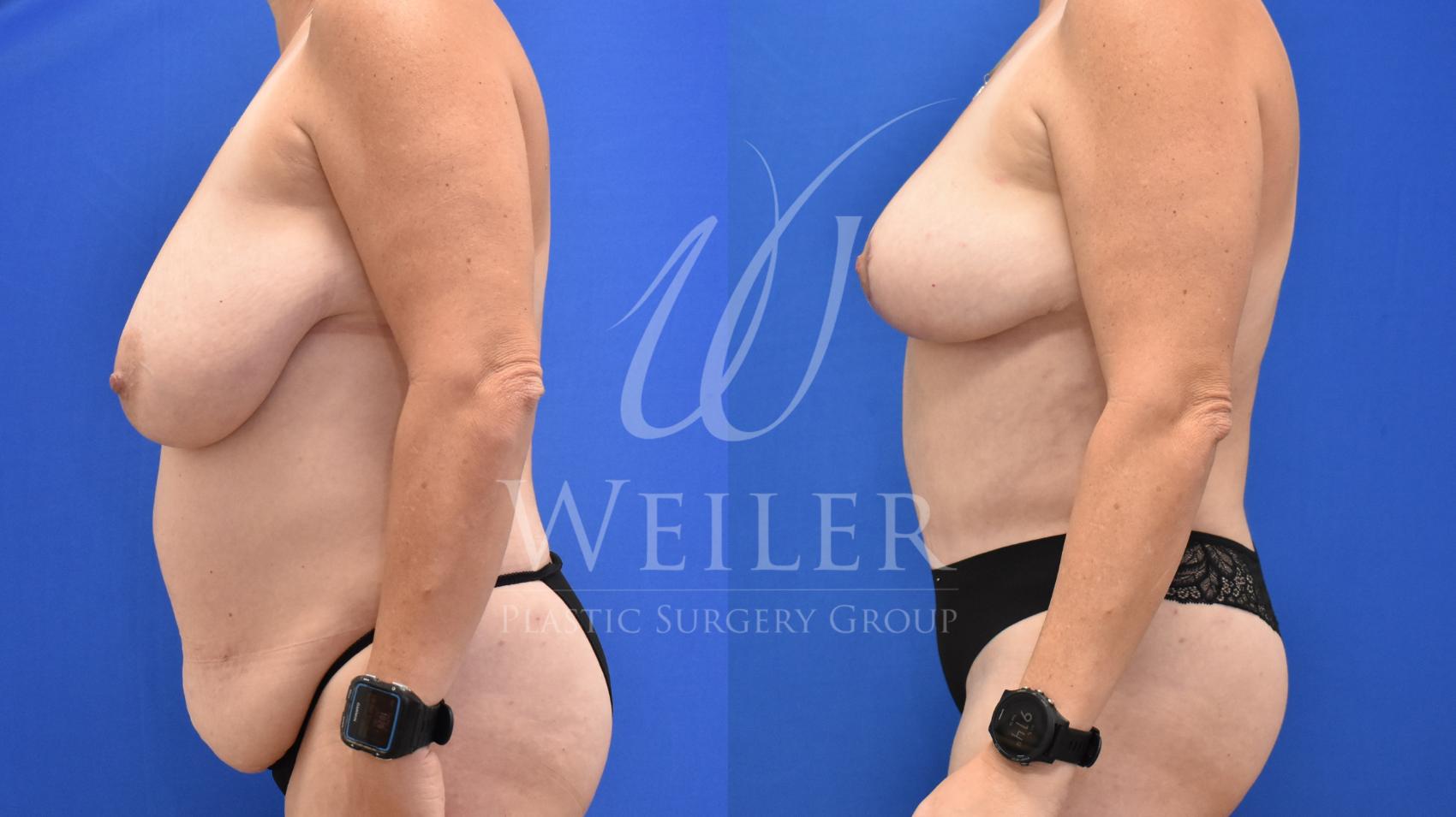 Before & After Breast Lift Case 806 Left Side View in Baton Rouge, Louisiana