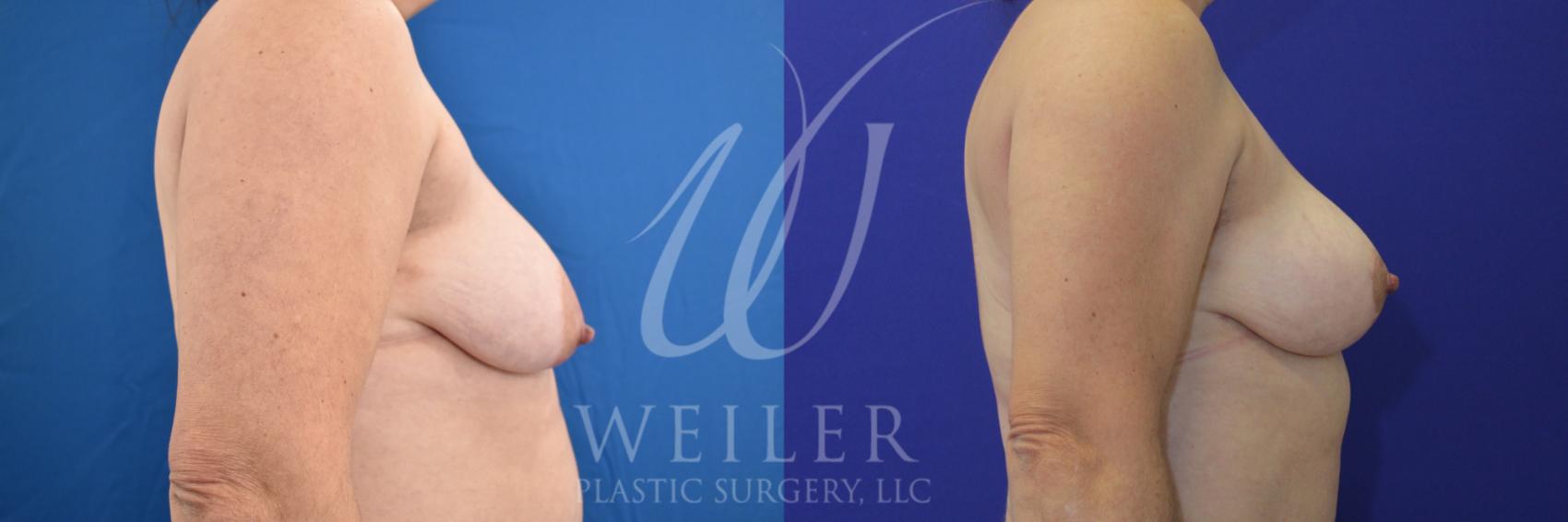 Before & After Breast Lift Case 920 Right Side View in Baton Rouge, Louisiana
