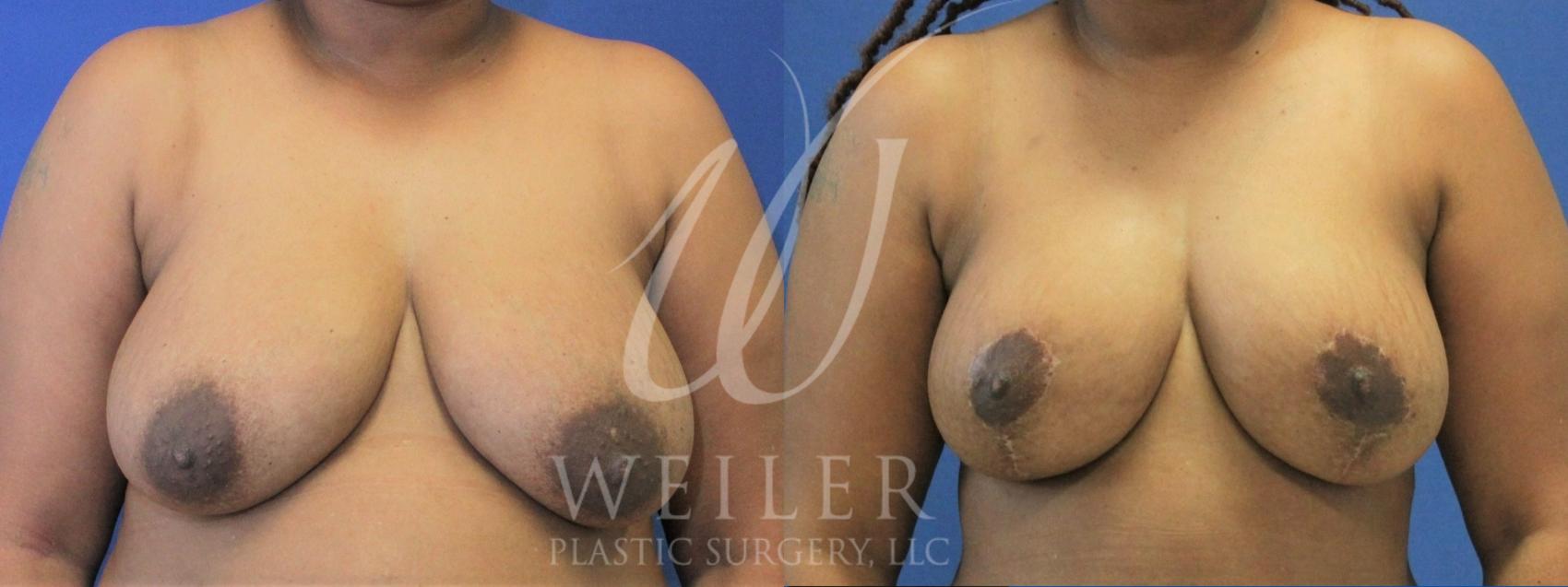 Before & After Breast Lift Case 940 Front View in Baton Rouge, Louisiana