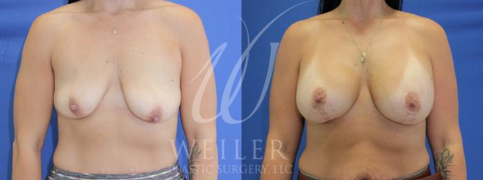 Before & After Breast Lift with Augmentation Case 1014 Front View in Baton Rouge, New Orleans, & Lafayette, Louisiana