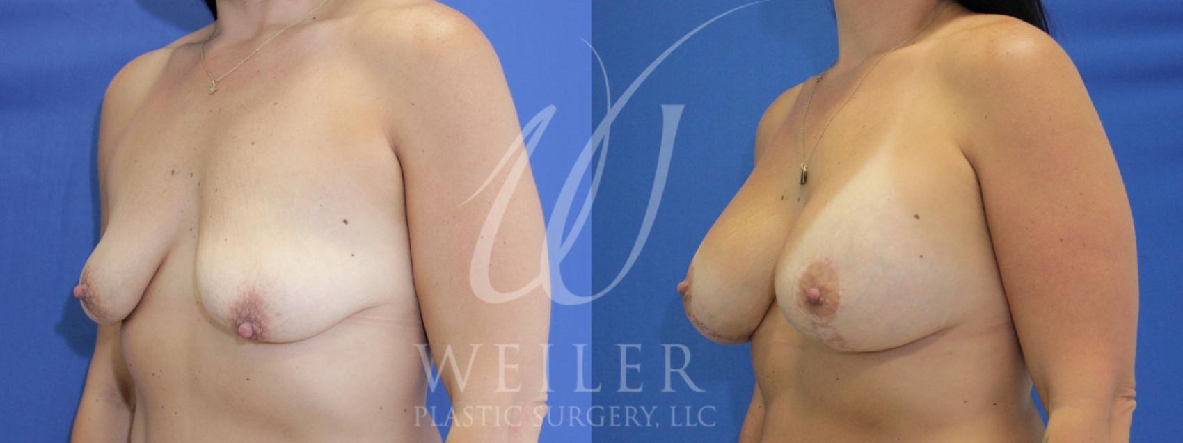 Before & After Breast Lift with Augmentation Case 1014 Left Oblique View in Baton Rouge, New Orleans, & Lafayette, Louisiana