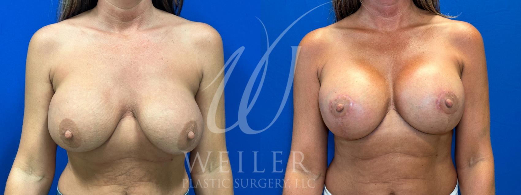 Before & After Breast Lift with Augmentation Case 1041 Front View in Baton Rouge, New Orleans, & Lafayette, Louisiana