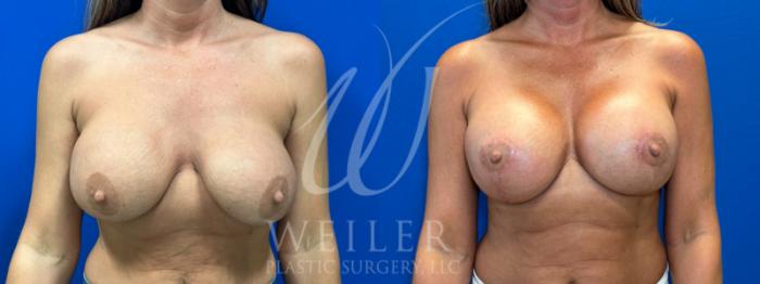Before & After Breast Lift with Augmentation Case 1041 Front View in Baton Rouge, New Orleans, & Lafayette, Louisiana