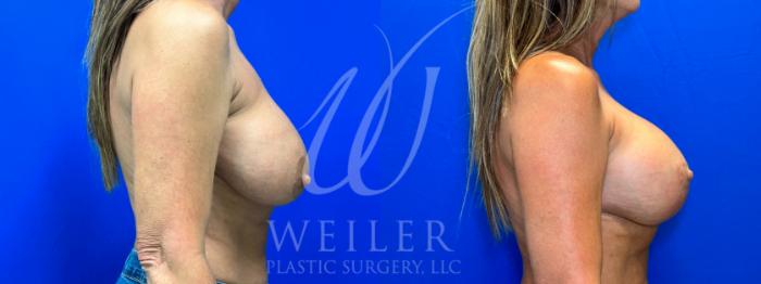 Before & After Breast Lift with Augmentation Case 1041 Right Side View in Baton Rouge, New Orleans, & Lafayette, Louisiana