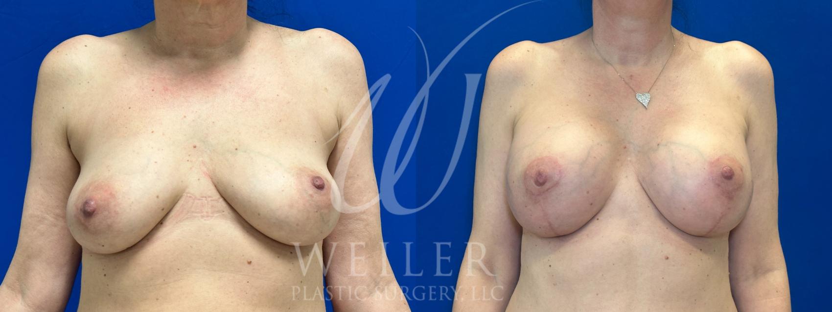Before & After Breast Lift with Augmentation Case 1053 Front View in Baton Rouge, Louisiana