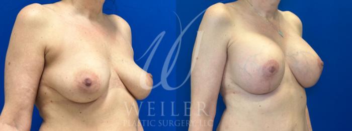 Before & After Breast Lift with Augmentation Case 1053 Right Oblique View in Baton Rouge, New Orleans, & Lafayette, Louisiana