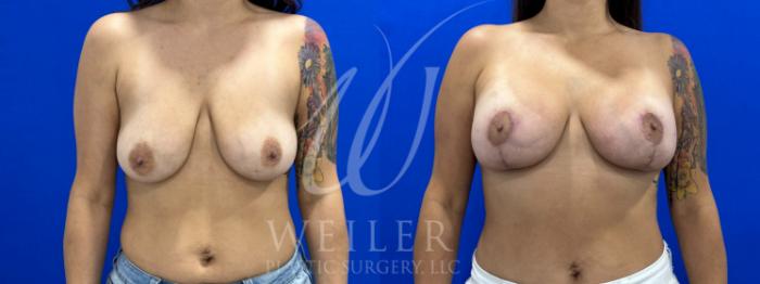 Before & After Breast Lift with Augmentation Case 1057 Front View in Baton Rouge, New Orleans, & Lafayette, Louisiana