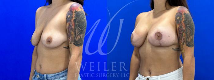 Before & After Breast Lift with Augmentation Case 1057 Left Oblique View in Baton Rouge, New Orleans, & Lafayette, Louisiana
