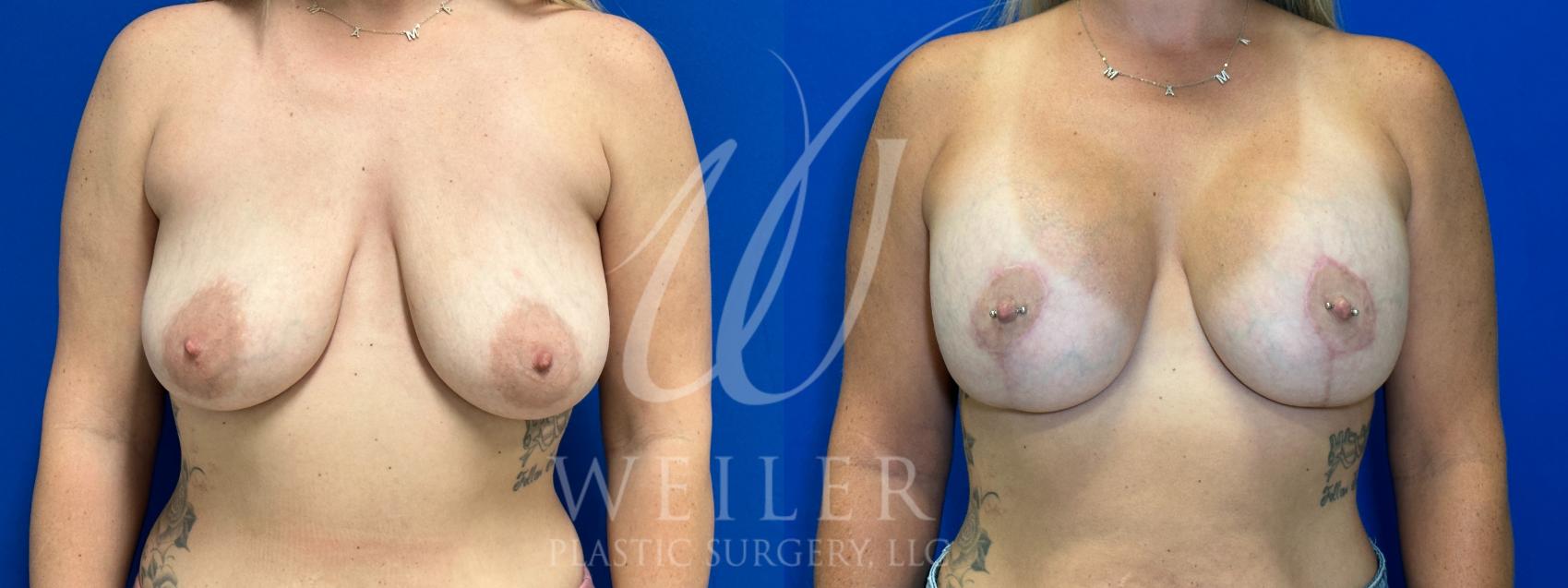 Before & After Breast Lift with Augmentation Case 1061 Front View in Baton Rouge, New Orleans, & Lafayette, Louisiana