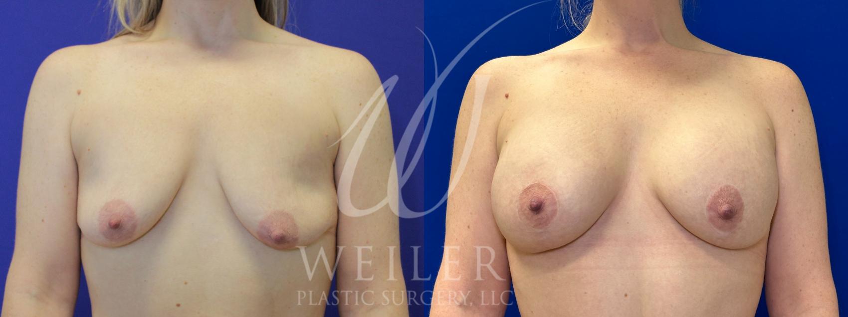 Before & After Breast Lift with Augmentation Case 1071 Front View in Baton Rouge, New Orleans, & Lafayette, Louisiana