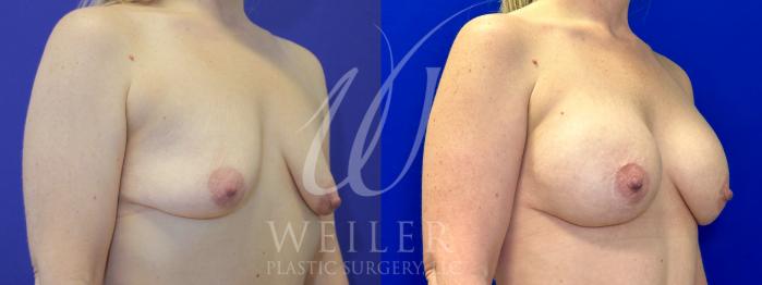 Before & After Breast Lift with Augmentation Case 1071 Right Oblique View in Baton Rouge, New Orleans, & Lafayette, Louisiana