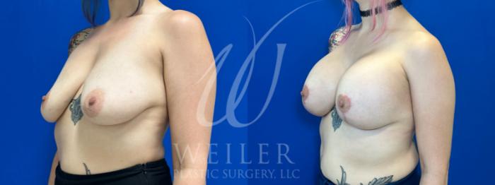 Before & After Breast Lift with Augmentation Case 1092 Left Oblique View in Baton Rouge, New Orleans, & Lafayette, Louisiana