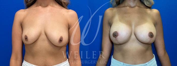 Before & After Breast Lift with Augmentation Case 1093 Front View in Baton Rouge, New Orleans, & Lafayette, Louisiana