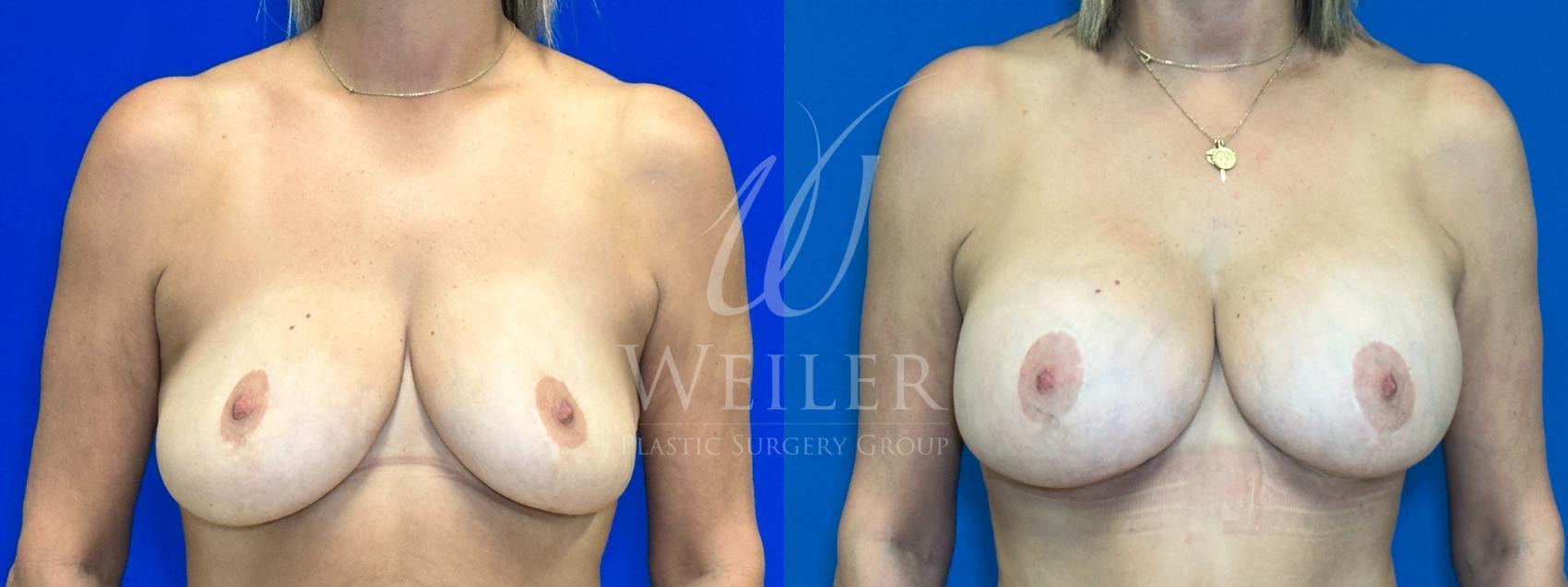 Before & After Breast Lift with Augmentation Case 1124 Front View in Baton Rouge, New Orleans, & Lafayette, Louisiana