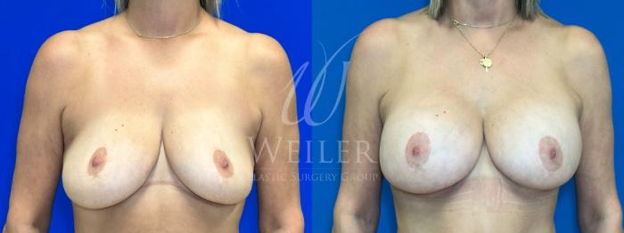 Before & After Breast Lift with Augmentation Case 1124 Front View in Baton Rouge, New Orleans, & Lafayette, Louisiana
